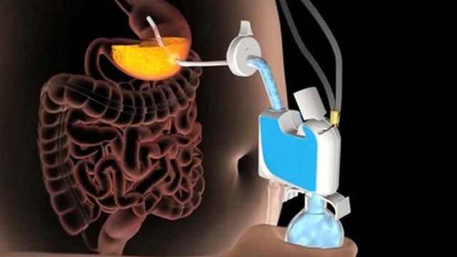 PHOTO: The AspireAssist stomach pump sucks food out of the user's belly before the body can fully digest it.