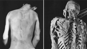 Girl Suffers Rare Disease That Turns Muscle Into Bone
