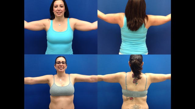 PHOTO: These photos show Dr. Aaron Rollins patient Blanca Ramirez before and after he performed his patented liposuction procedure on her arms.