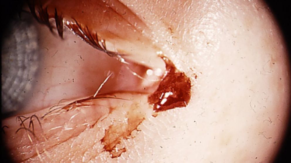 PHOTO: Unexplained bloody tears are extremely rare.