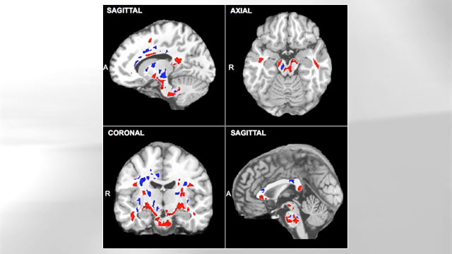 PHOTO: A set of brain scans showing evidence of concussions. The areas in red show where the concussion damage is present.