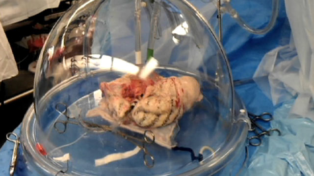 PHOTO: Doctors keep a donated lung "breathing" until it can be transplanted into a recipient in need.