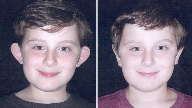 PHOTO Brian Donoghue, an 11-year-old from Long Island, N.Y., had plastic surgery to reduce the size of his ears.