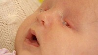 Photo: Baby Born With No Eyes