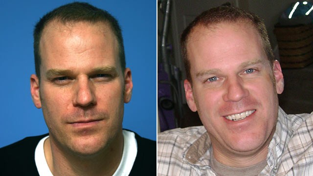 PHOTO: Marc, who chose not to share his last name, is shown before, left, and after botox.