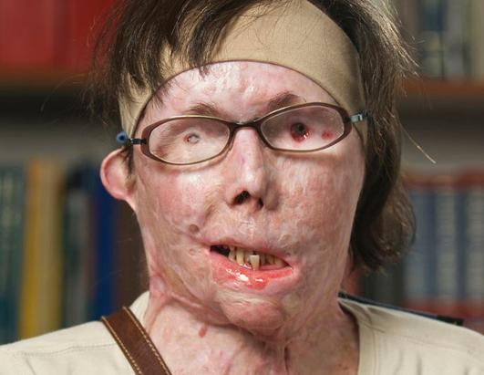 Face Transplant Patient's Transformation