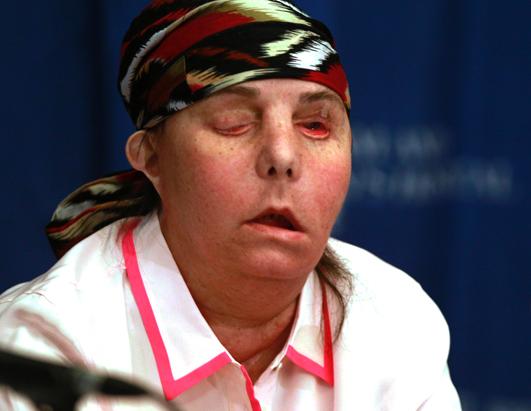 Face Transplant Patient's Transformation
