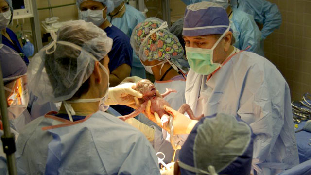 PHOTO:Â Dr. Bill McKenzie delivers Carroll sextuplet Baby A at 8:5 a.m. on Saturday. Photo credit : Daphney Walker, RN, Brookwood Medical Center. Dr. Bill McKenzie delivers Carroll sextuplet Baby C at 8:06 a.m. on June 18, 2011.