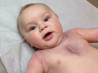 Baby With Rare Disease Gets Help From Strangers