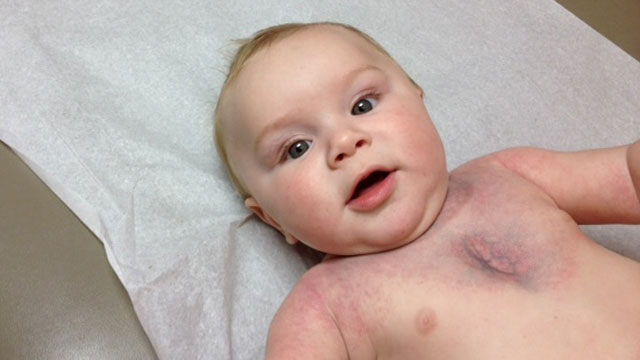 Baby With Rare Disease Closer To Getting Life-Saving ...