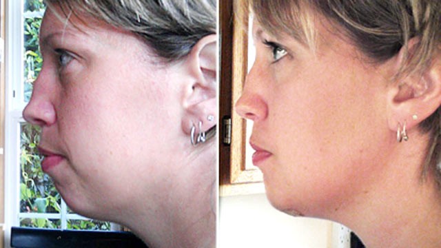 PHOTO: Cary Houghton Anderson underwent a chin augmentation in October, 2011.