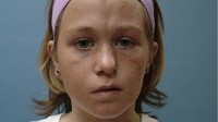 PHOTO Christine Honeycutt, 11, suffers from Parry-Romberg Syndrome, a rare condition that causes half the face to waste away.