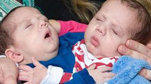 PHOTO Irish-born conjoined twins Hassan and Hussein Benhaffaf are shown in this file photo.