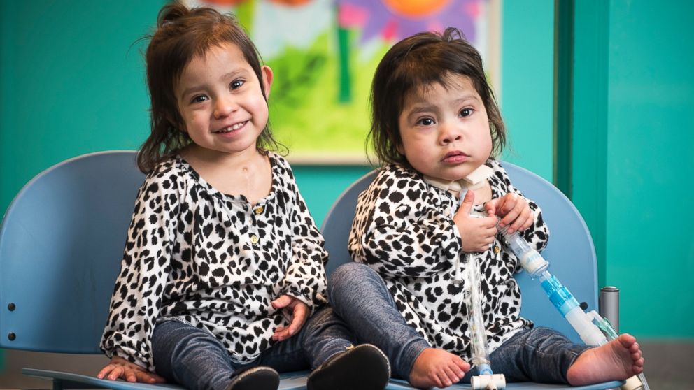 Formerly Conjoined Texas Twins Celebrate One Year Since Separation