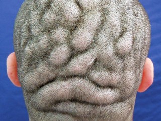 Rare Condition Causes 'Brainy' Scalp