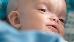 PHOTO: Dominic Gundrum was born with a Tessier midline facial cleft and an encephalocele.