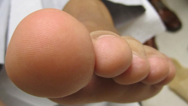 big big toe