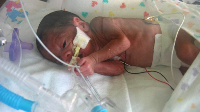 PHOTO: Premature baby Ethan Pugh, son of pediatrician Dr. Bonnie Pugh, was born at 24 weeks and 6 days. He required a ventilator to help him breathe for the first month of his life.