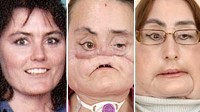 Photo: First U.S. Face Transplant Patient Appears Before Cameras: Connie Culp, 46, Said She Is Grateful for the Ways the Surgery Changed Her Life