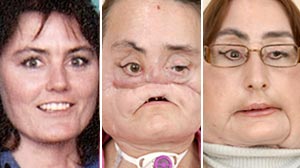 Face Transplant: 'Resilience' Saw Woman Through - ABC News