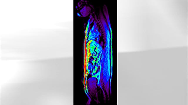 PHOTO: The drug Adipotide targets body fat (shown in red) and helped obese monkeys lose weight, according to a new study.