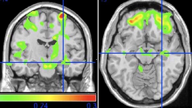 PHOTO: Researchers from University of Pittsburgh Medical Center tracked fish consumption and measured brain volume and memory function in 260 cognitively normal adults over 10 years.