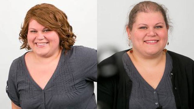 PHOTO: Lillian White has been losing her hair since she was 11 due to a hereditary condition.