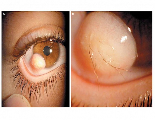 Man With a Hairy Eyeball