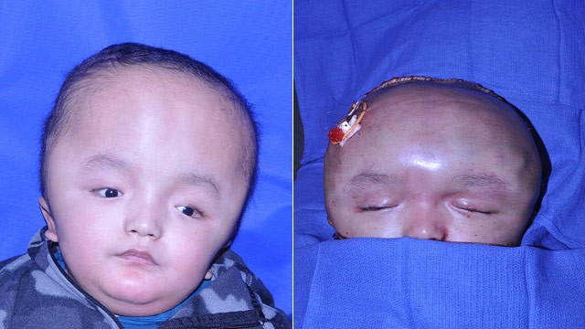 PHOTO: Doctors used computer modelling to plan skull surgery for 7-year-old Dawa Titung, who was born with an extremely large head.