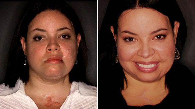 PHOTO: Ilianexy Morales was knifed more than 100 times by a possessive boyfriend and required multiple surgeries before getting free plastic surgery from Face to Face.