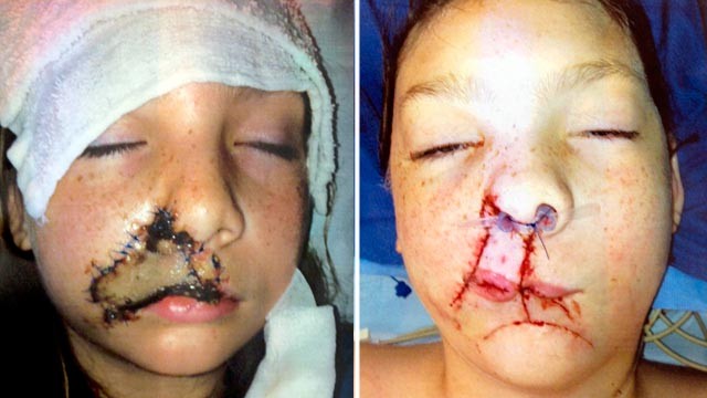 PHOTO: Before and after plastic surgery images of Jacklyn Tucker, an 11-yr-old who was attacked by a dog, at a press conference at Joe DiMaggio Children's Hospital in Hollywood, Fla. on July 6, 2012.