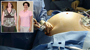 Photo: Bariatric Surgery