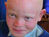 Beauty of Albinism