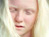 Beauty of Albinism