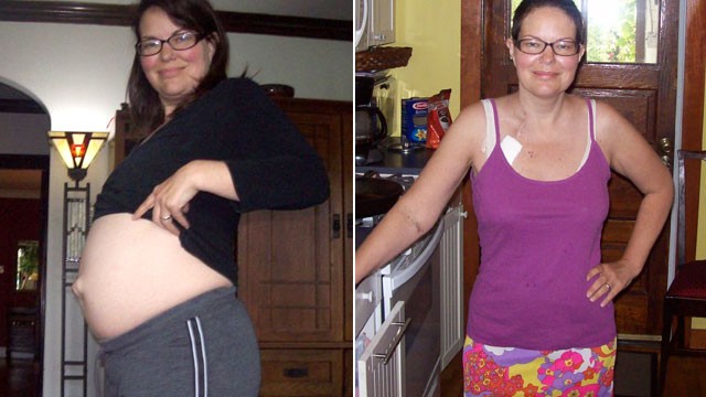 PHOTO: Lindsay Porter had enlarged kidneys because of a genetic disease and needed a transplant.