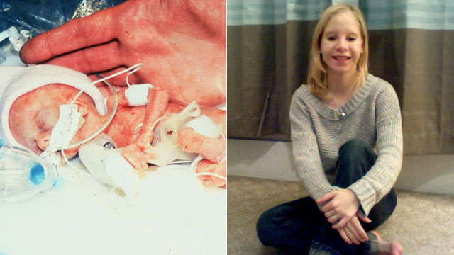 PHOTO: Preemies among worlds smallest to survive defying odds