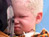 Beauty of Albinism