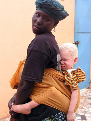 Beauty of Albinism