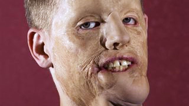 PHOTO: Mitch Hunter after surgery