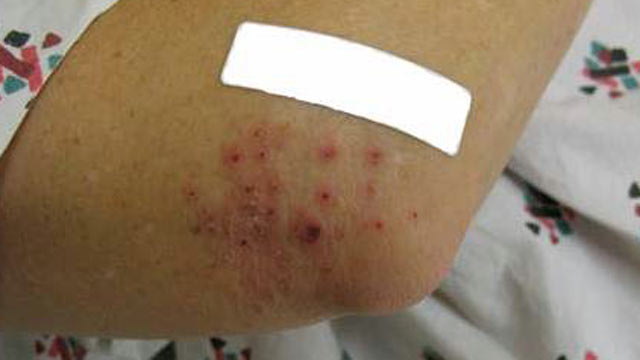 PHOTO: Skin lesions typical of Morgellons, some containing blue fibers.
