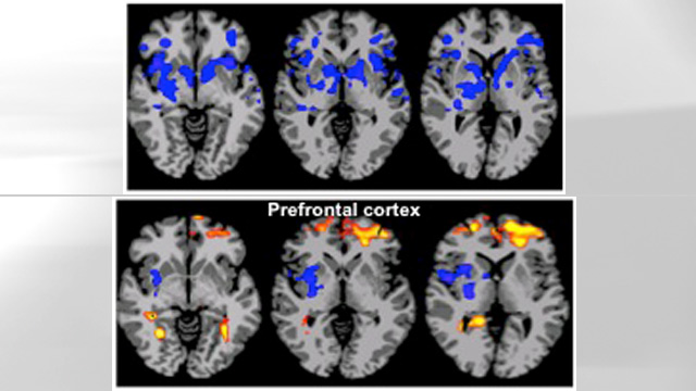 PHOTO: Brain scans of obese and lean people