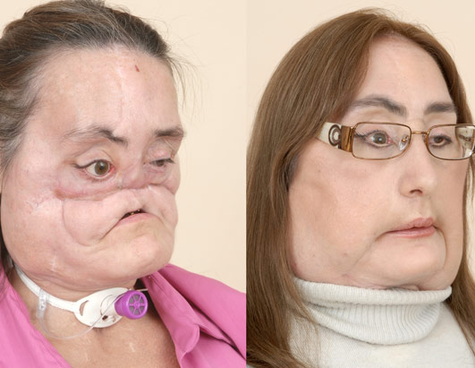 Face Transplant 