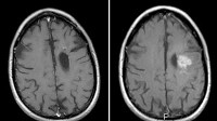 Photo: Change of Address Changes Outlook for Brain Cancer Patient