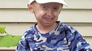 PHOTO Ory Barnett suffered from progeria, an extremely rare and fatal disease characterized by what resembles premature aging in children.