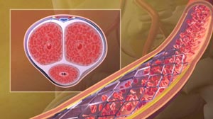 PHOTO: Pelvic Stent