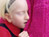 Beauty of Albinism
