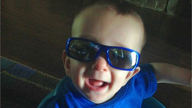 PHOTO: Six-month-old Ryan Burke had surgery to reshape his skull.