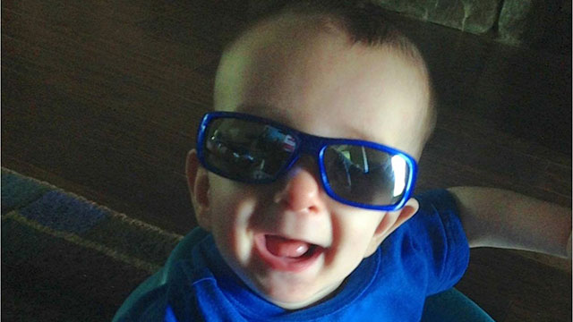 PHOTO: Six-month-old Ryan Burke had surgery to reshape his skull.