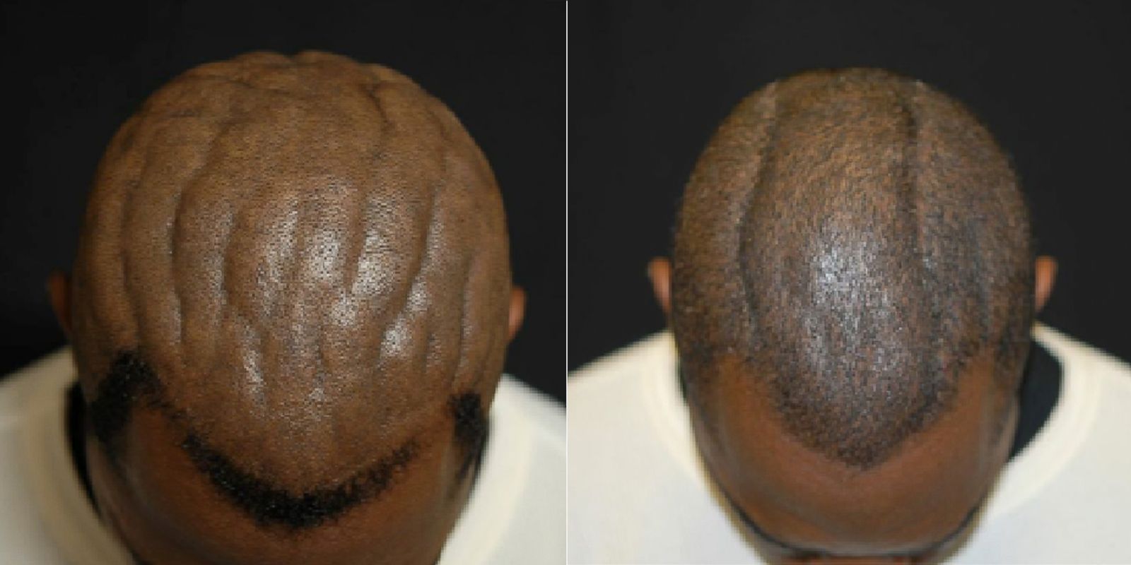 scalp-surgery-corrects-cutis-verticis-gyrata-picture-medical-marvels