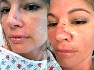 Indoor Tanning Tied to 170,000 Skin Cancers Annually